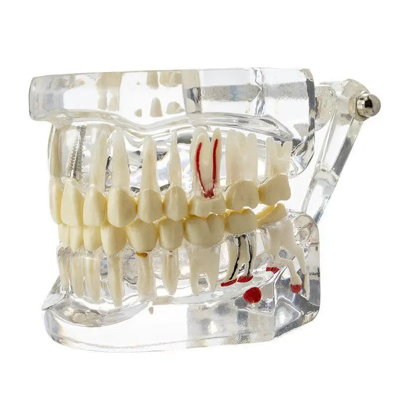 Dental Implant & Bridge Teaching Model – 28 Tooth Set Dental Teaching Model Babs