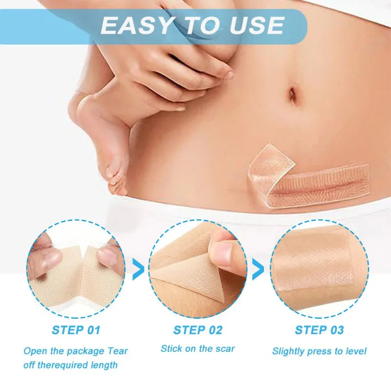 Silicone Scar Gel Sheets Roll – Reusable 4×150cm Strips Silicone Scar Sheets Babs