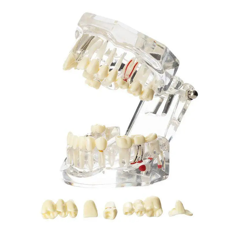 Dental Implant & Bridge Teaching Model – 28 Tooth Set Dental Teaching Model Babs
