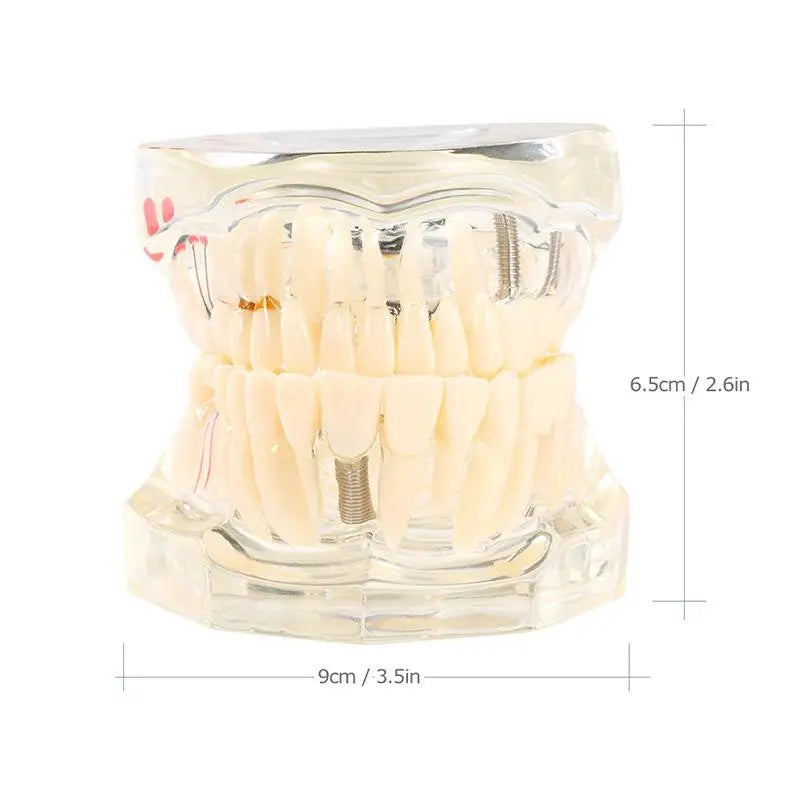 Dental Implant & Bridge Teaching Model – 28 Tooth Set Dental Teaching Model Babs