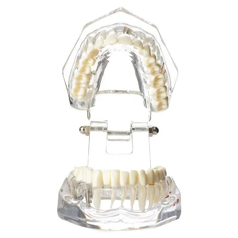 Dental Implant & Bridge Teaching Model – 28 Tooth Set Dental Teaching Model Babs 1pc