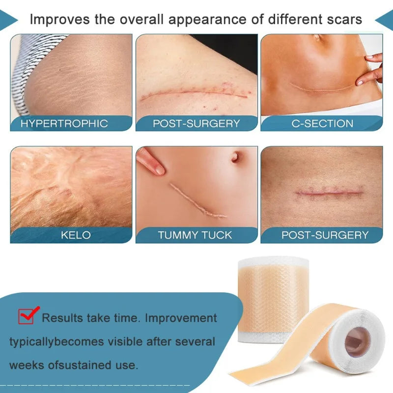 Silicone Scar Gel Sheets Roll – Reusable 4×150cm Strips Silicone Scar Sheets Babs