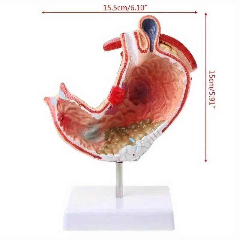 Human Anatomy Stomach Model – Gastric Pathology Teaching Aid Anatomy Teaching Model Babs