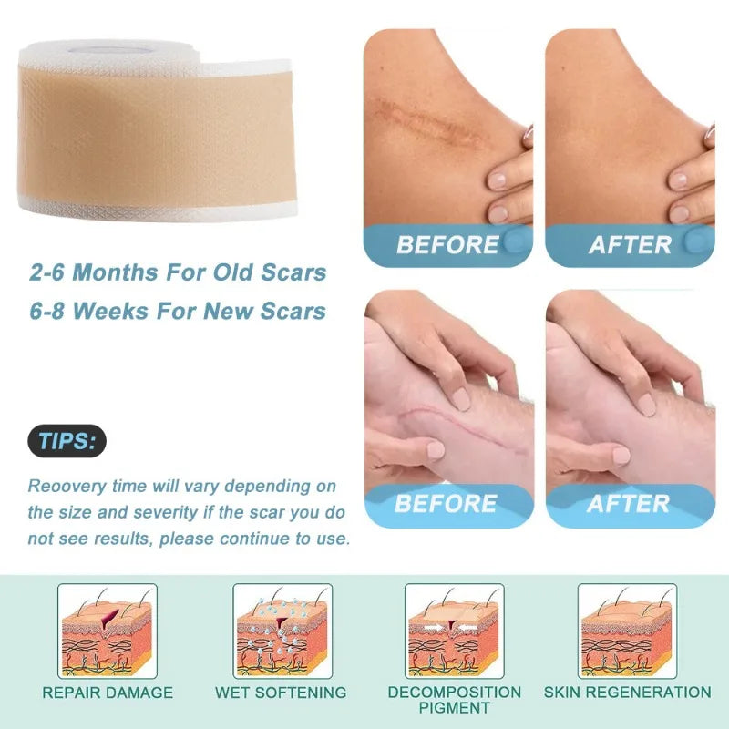 Silicone Scar Gel Sheets Roll – Reusable 4×150cm Strips Silicone Scar Sheets Babs