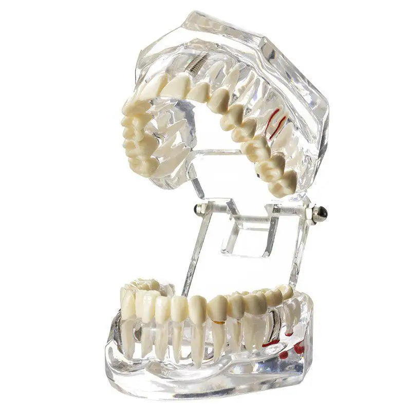 Dental Implant & Bridge Teaching Model – 28 Tooth Set Dental Teaching Model Babs